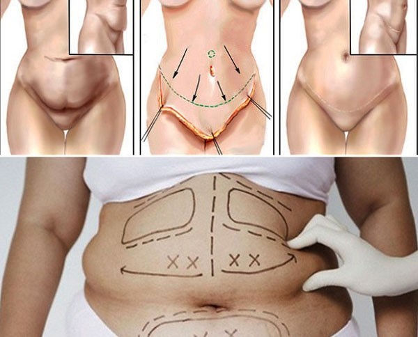 Những ưu điểm của phẫu thuật tạo hình thành bụng