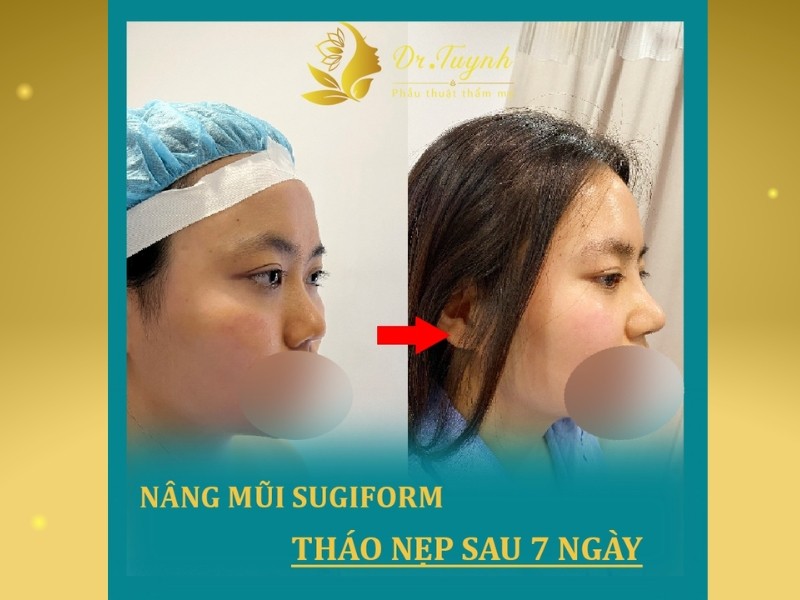 Dr.Tuynh đơn vị phẫu thuật nâng mũi an toàn, uy tín