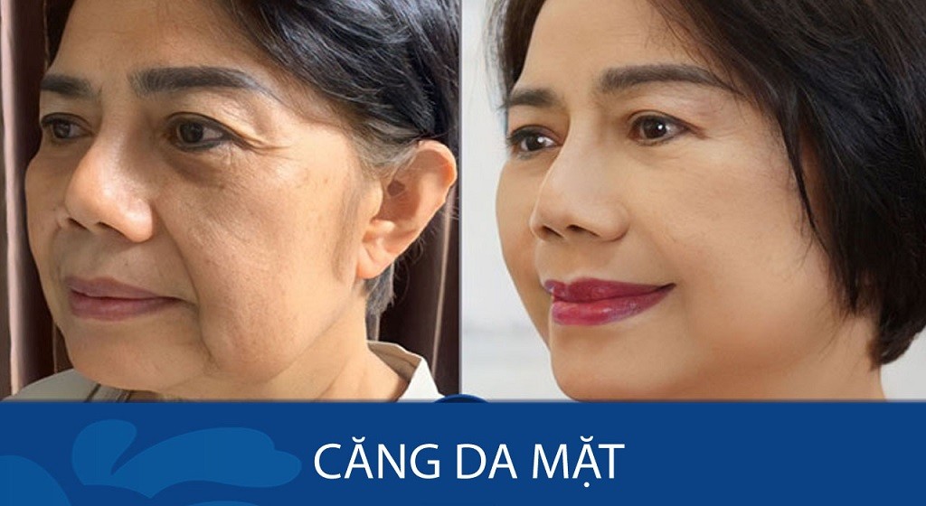 Căng da mặt là gì?