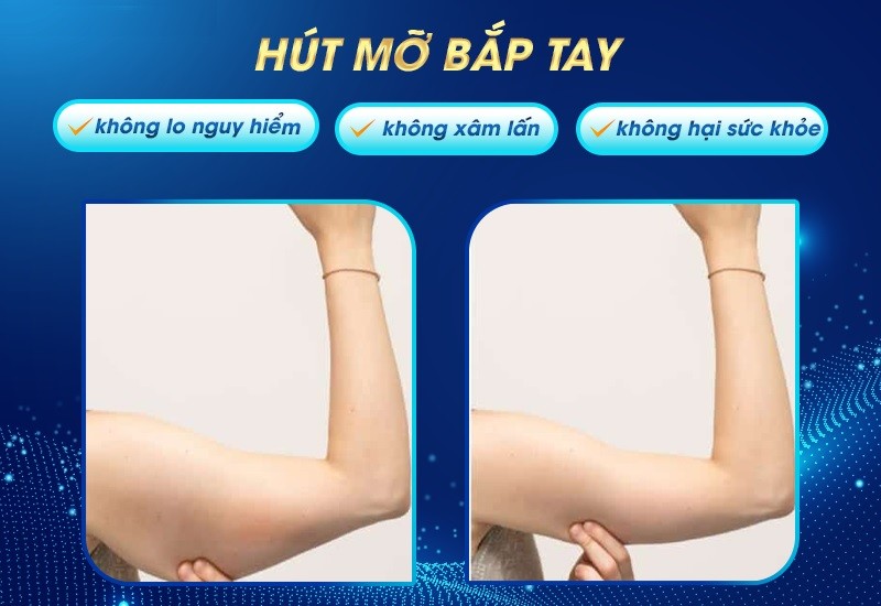 Dịch vụ hút mỡ bắp tay