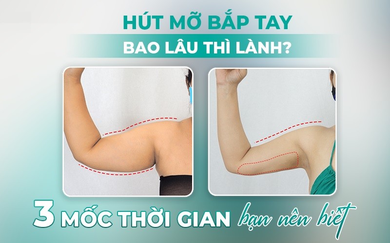 Hút mỡ bắp tay bao lâu thì lành