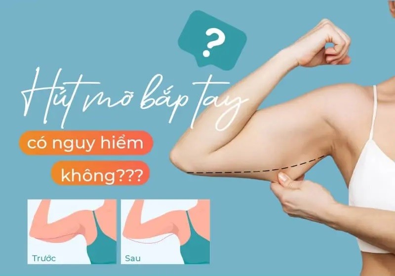 Hút mỡ bắp tay có nguy hiểm không?