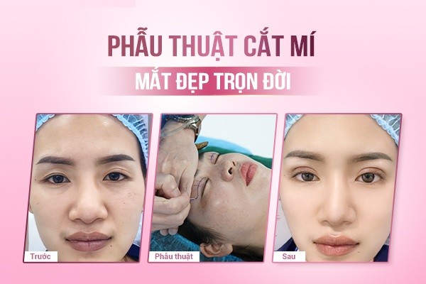 Phẫu thuật cắt mí mắt có đau không?