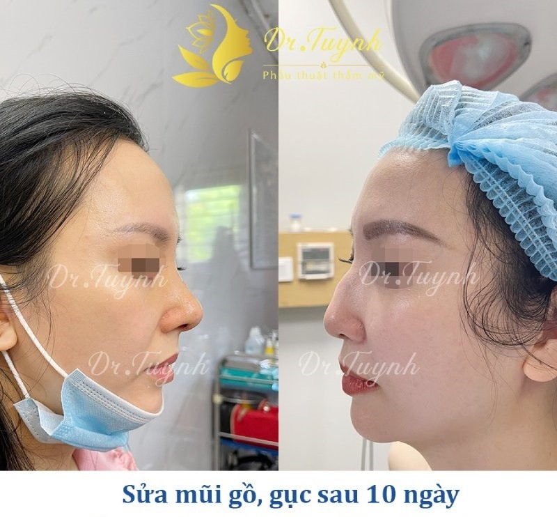 Nâng mũi sửa lại