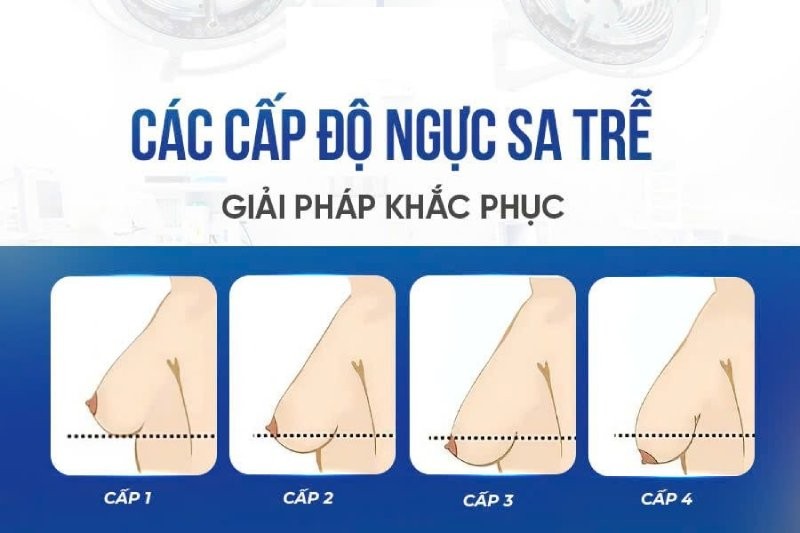 Các cấp độ ngực sa trễ