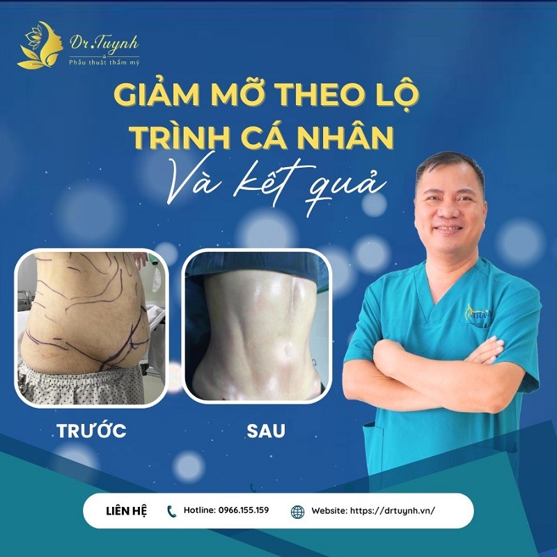 Cách giảm mỡ 2 bên hông hiệu quả