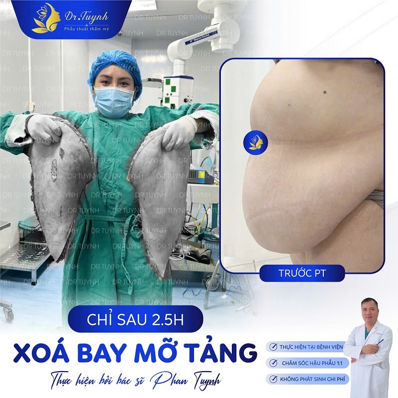 Thực hiện cắt mỡ bụng tại Dr. Tuynh