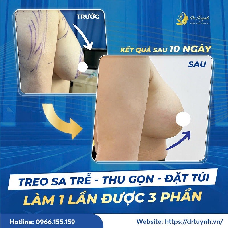 Dr. Tuynh - Phẫu thuật ngực sa trễ