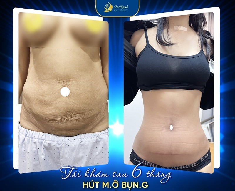 Hút mỡ bụng tại Dr. Tuynh