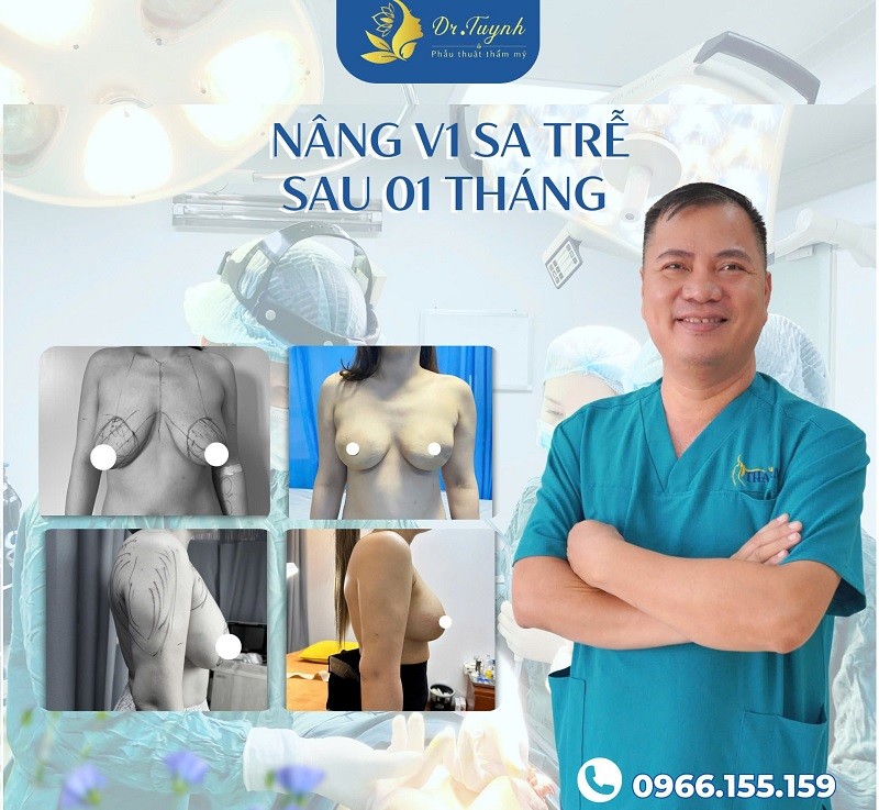 Phẫu thuật nâng ngực cải thiện vòng 1 chảy xệ