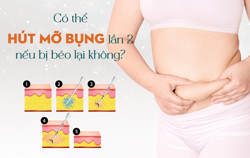 Có thể hút mỡ bụng lần 2 nếu bị béo lại không?