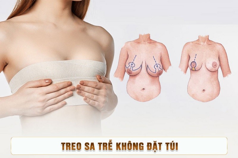 Đối tượng nên treo sa trễ không đặt túi