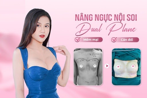 Lợi ích của nâng ngực Dual Plane