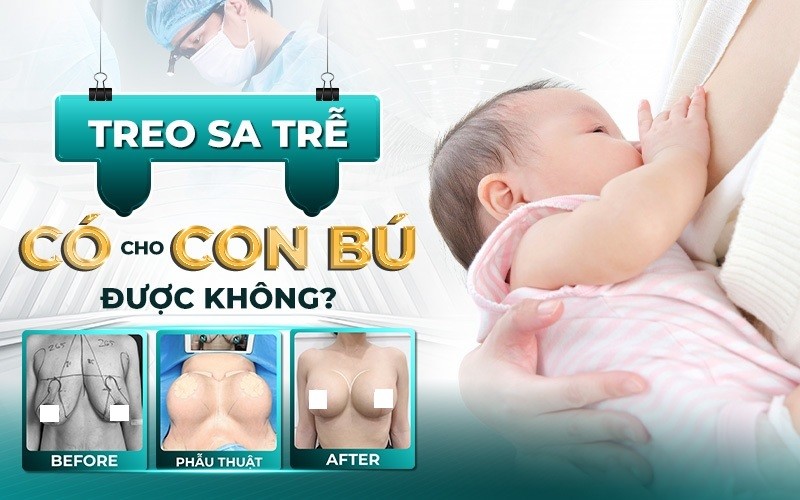 Treo sa trễ có cho con bú được không?