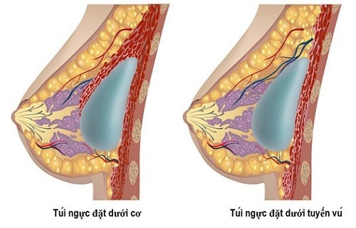 Vị trí đặt túi ngực khi nâng ngực đường quầng