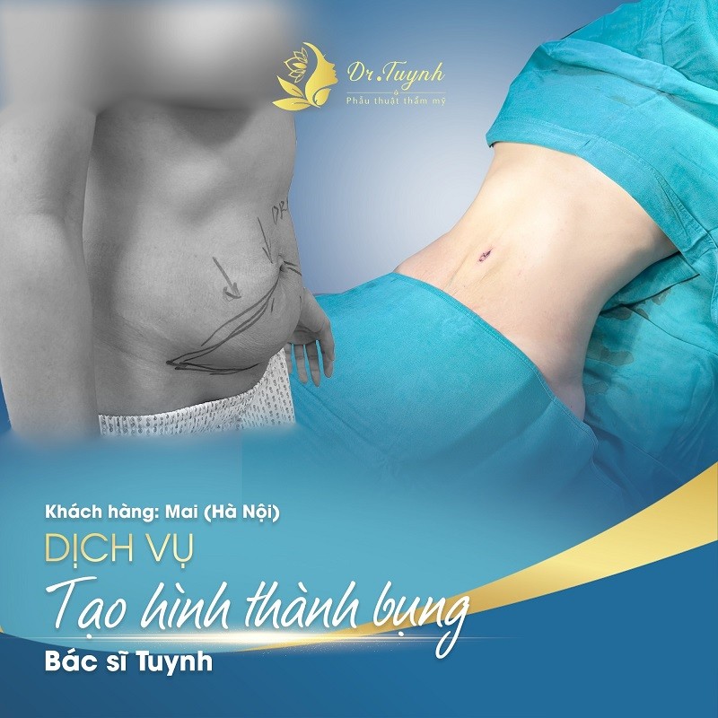 Địa chỉ tạo hình thành bụng Dr. Tuynh