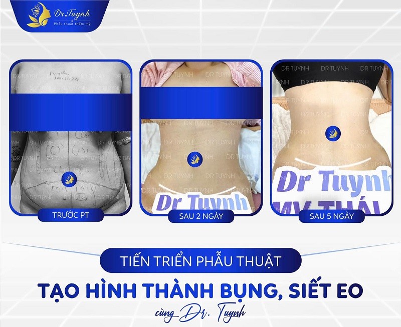 Phẫu thuật tạo hình thành bụng