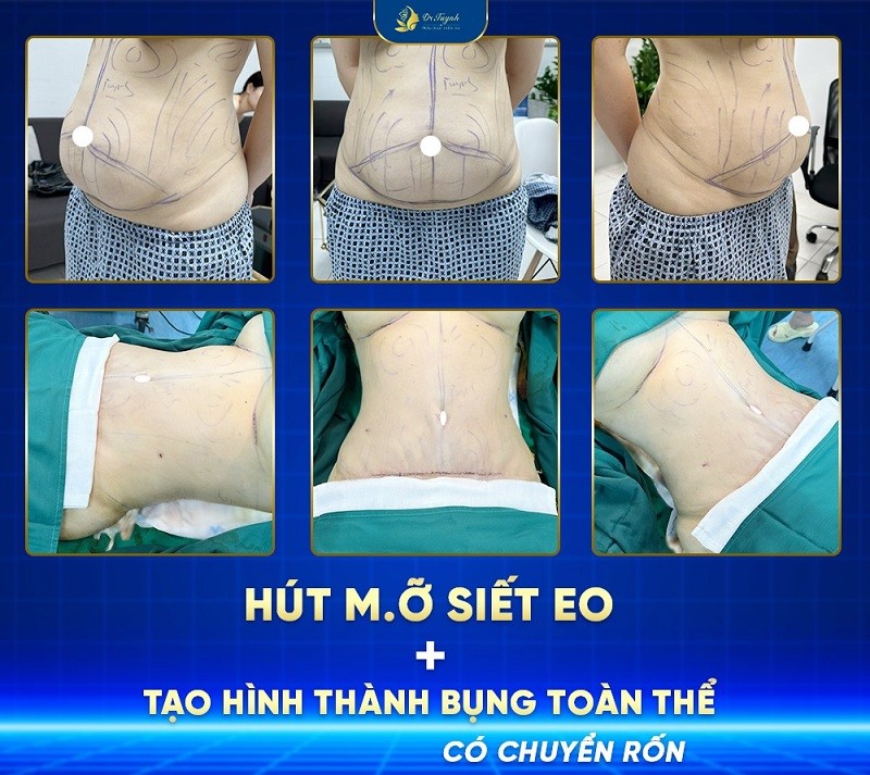 Tạo hình thành bụng có đắt không?